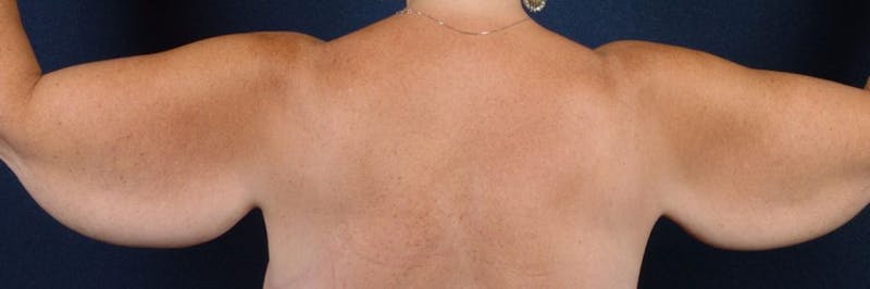 Brachioplasty Before & After Gallery - Patient 9691135 - Image 3