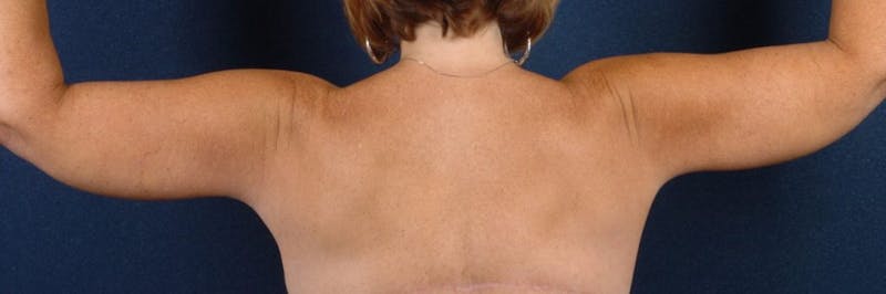 Brachioplasty Before & After Gallery - Patient 9691135 - Image 4