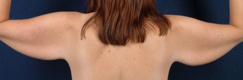 Brachioplasty Before & After Gallery - Patient 9691139 - Image 3