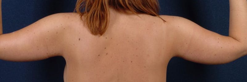 Brachioplasty Before & After Gallery - Patient 9691139 - Image 4