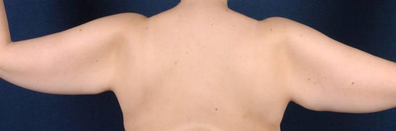 Brachioplasty Before & After Gallery - Patient 9691143 - Image 3