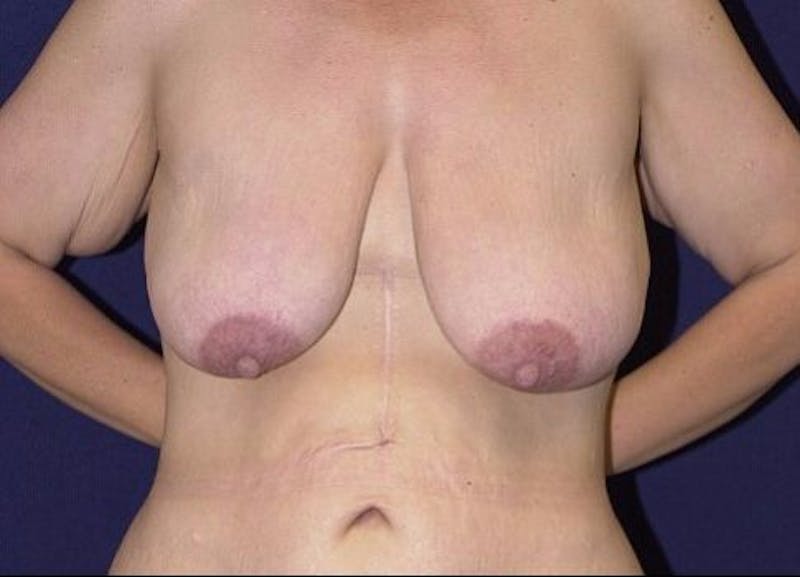 Breast Recontouring Before & After Gallery - Patient 9691202 - Image 1