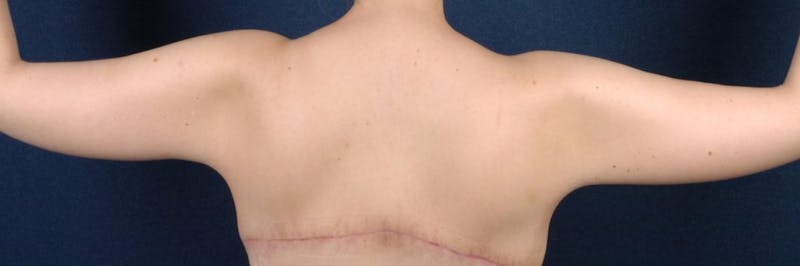 Brachioplasty Before & After Gallery - Patient 9691143 - Image 4