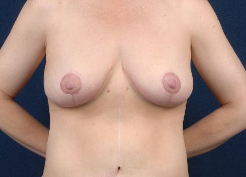 Breast Recontouring Before & After Gallery - Patient 9691202 - Image 2