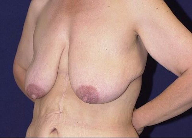 Breast Recontouring Gallery - Patient 9691202 - Image 3