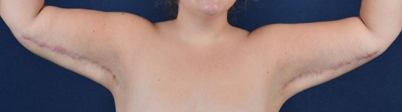Brachioplasty Before & After Gallery - Patient 9691201 - Image 2