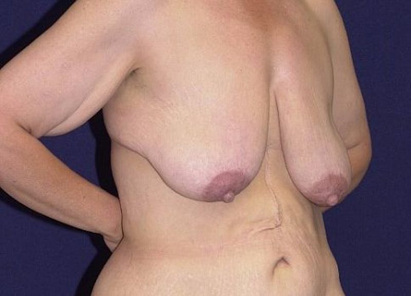 Breast Recontouring Gallery - Patient 9691202 - Image 5
