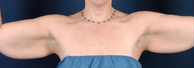 Brachioplasty Before & After Gallery - Patient 9691205 - Image 1