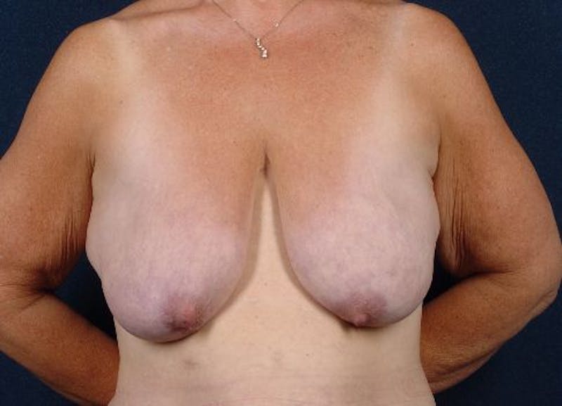 Breast Recontouring Before & After Gallery - Patient 9691207 - Image 1