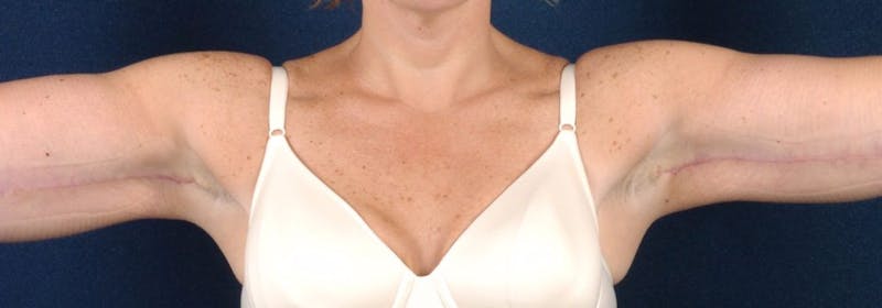 Brachioplasty Before & After Gallery - Patient 9691205 - Image 2