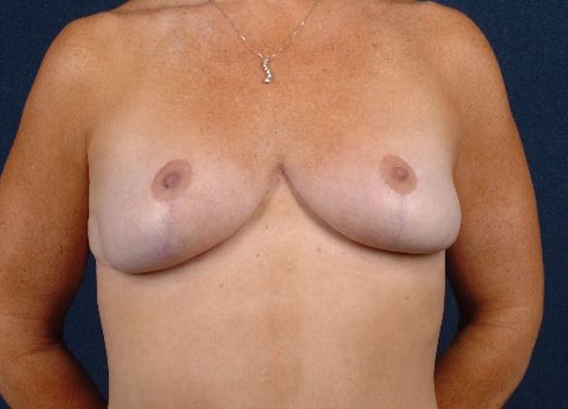 Breast Recontouring Before & After Gallery - Patient 9691207 - Image 2