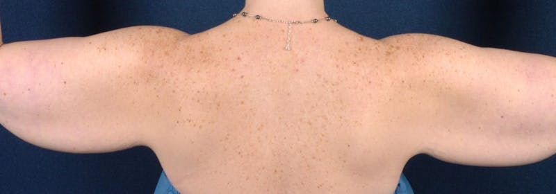 Brachioplasty Before & After Gallery - Patient 9691205 - Image 3