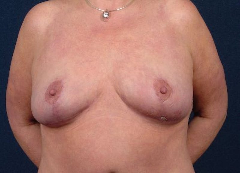 Breast Recontouring Before & After Gallery - Patient 9691212 - Image 2