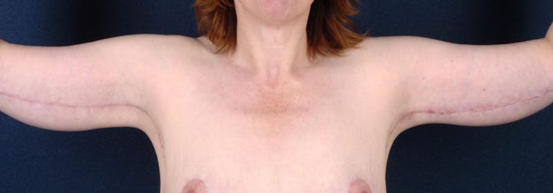 Brachioplasty Before & After Gallery - Patient 9691211 - Image 2