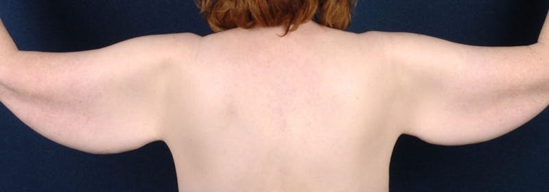 Brachioplasty Before & After Gallery - Patient 9691211 - Image 3