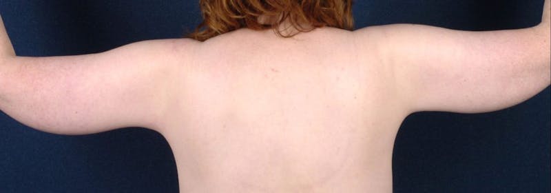 Brachioplasty Before & After Gallery - Patient 9691211 - Image 4