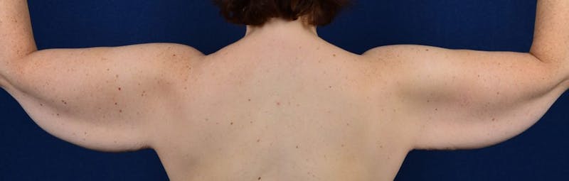 Brachioplasty Before & After Gallery - Patient 9691213 - Image 3
