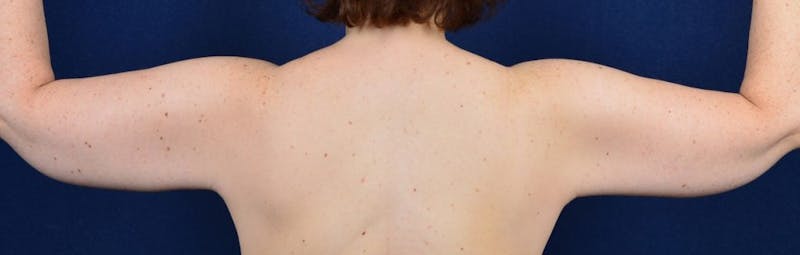 Brachioplasty Before & After Gallery - Patient 9691213 - Image 4