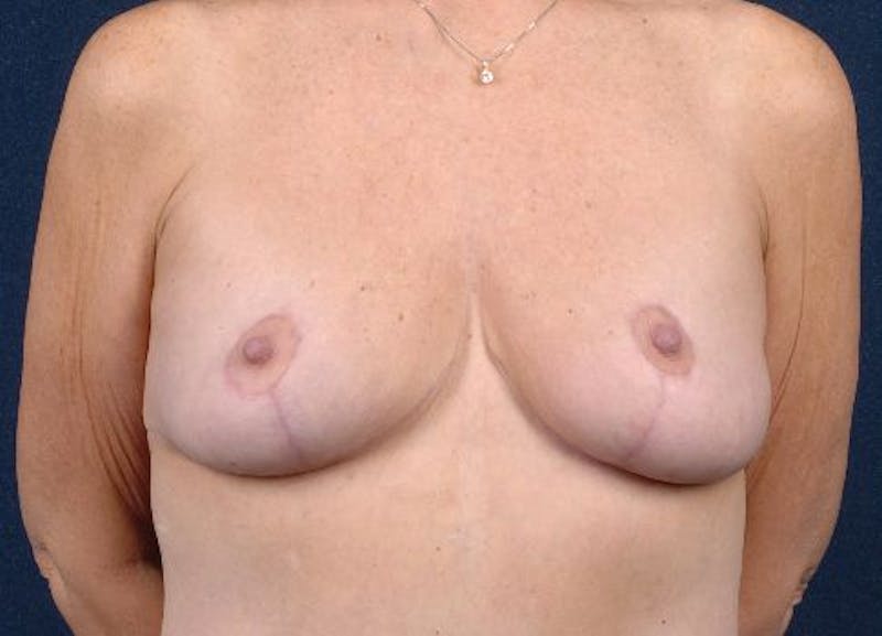 Breast Recontouring Before & After Gallery - Patient 9691228 - Image 2