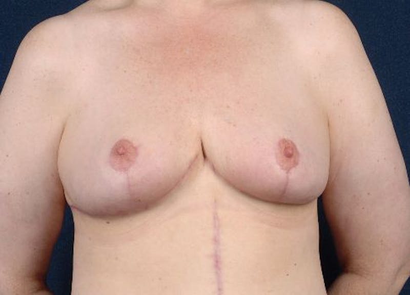Breast Recontouring Before & After Gallery - Patient 9691229 - Image 2