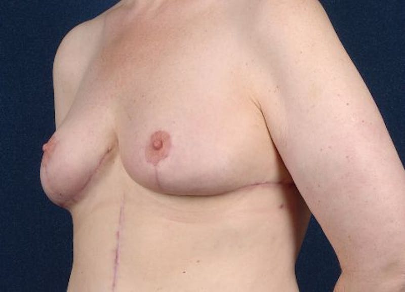 Breast Recontouring Gallery - Patient 9691229 - Image 4