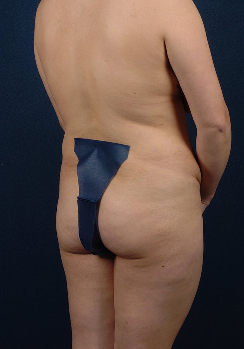 Buttock Recontouring Before & After Gallery - Patient 9694828 - Image 3