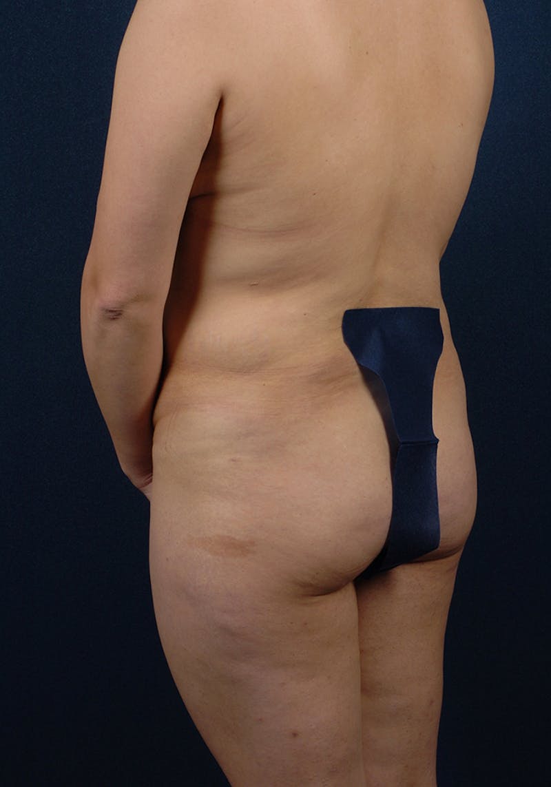 Buttock Recontouring Before & After Gallery - Patient 9694828 - Image 5
