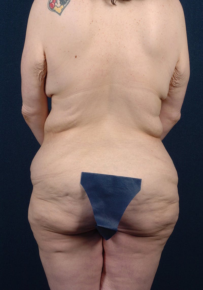 Buttock Recontouring Gallery - Patient 9694833 - Image 1