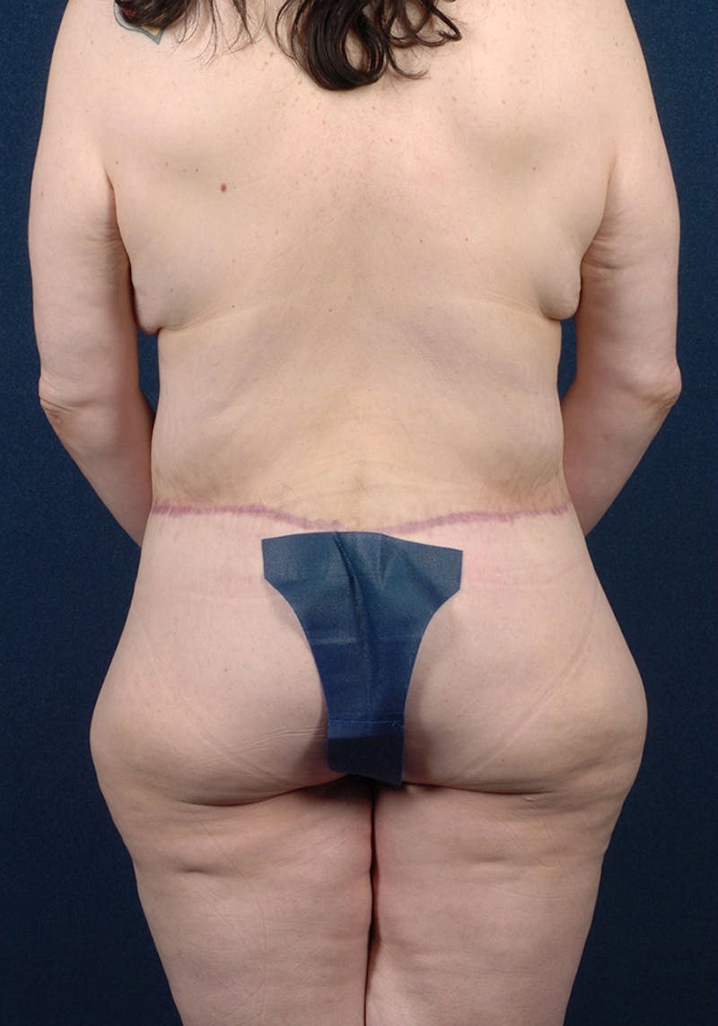 Buttock Recontouring Before & After Gallery - Patient 9694833 - Image 2