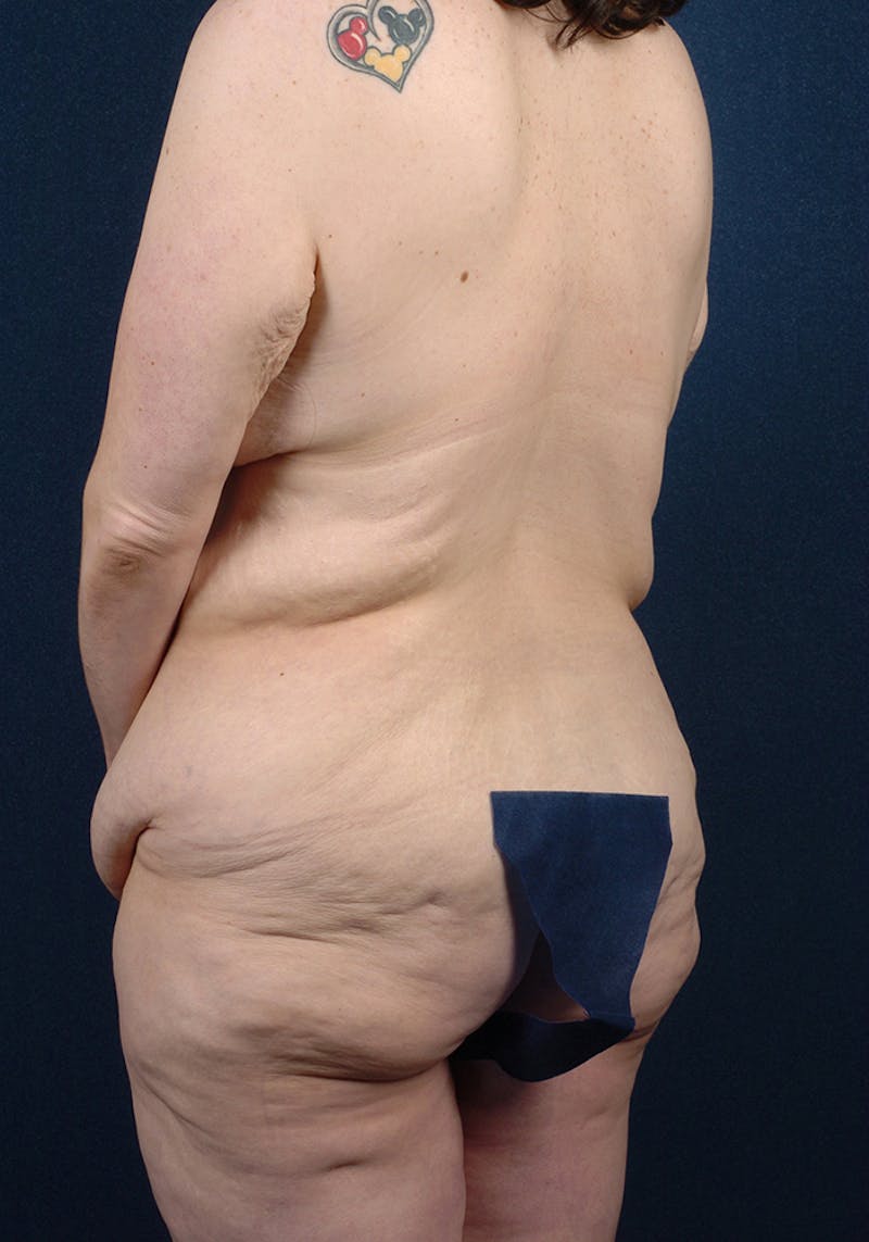 Buttock Recontouring Gallery - Patient 9694833 - Image 3