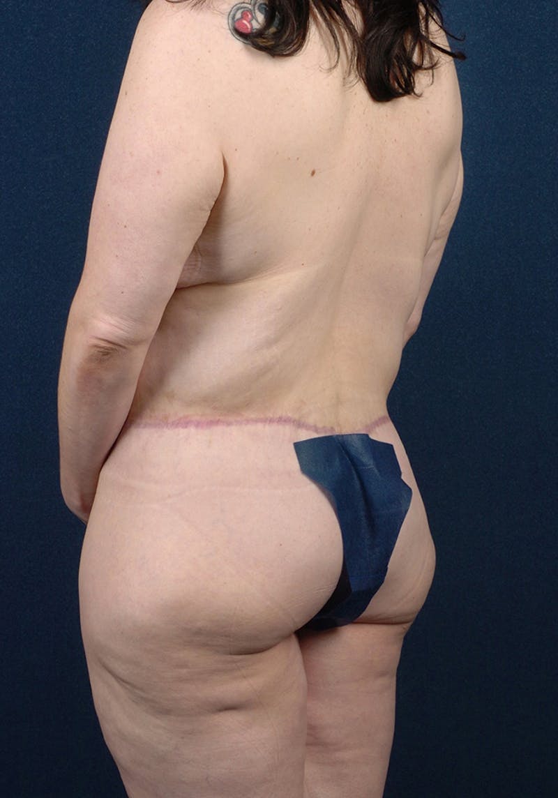Buttock Recontouring Gallery - Patient 9694833 - Image 4