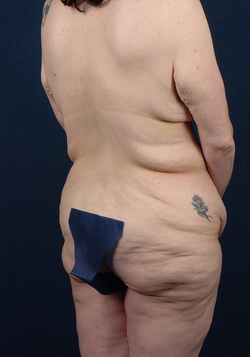 Buttock Recontouring Before & After Gallery - Patient 9694833 - Image 5