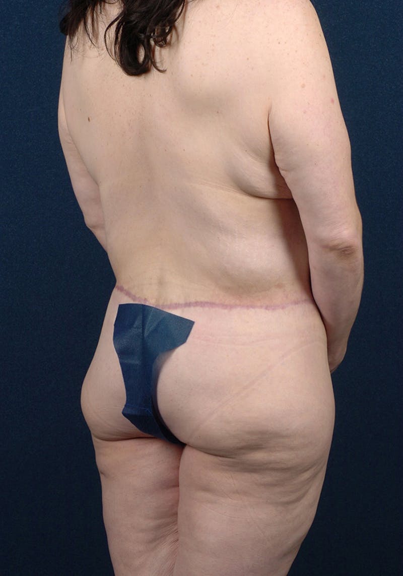 Buttock Recontouring Before & After Gallery - Patient 9694833 - Image 6