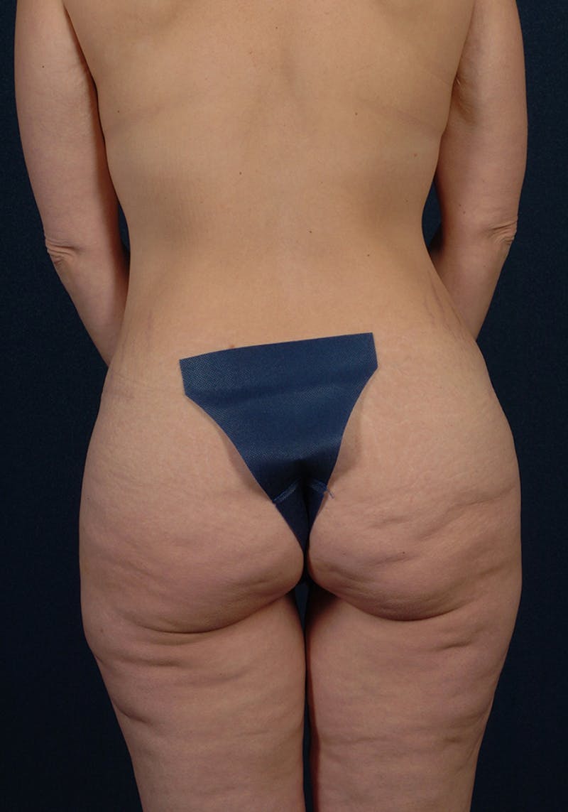 Buttock Recontouring Before & After Gallery - Patient 9694837 - Image 1