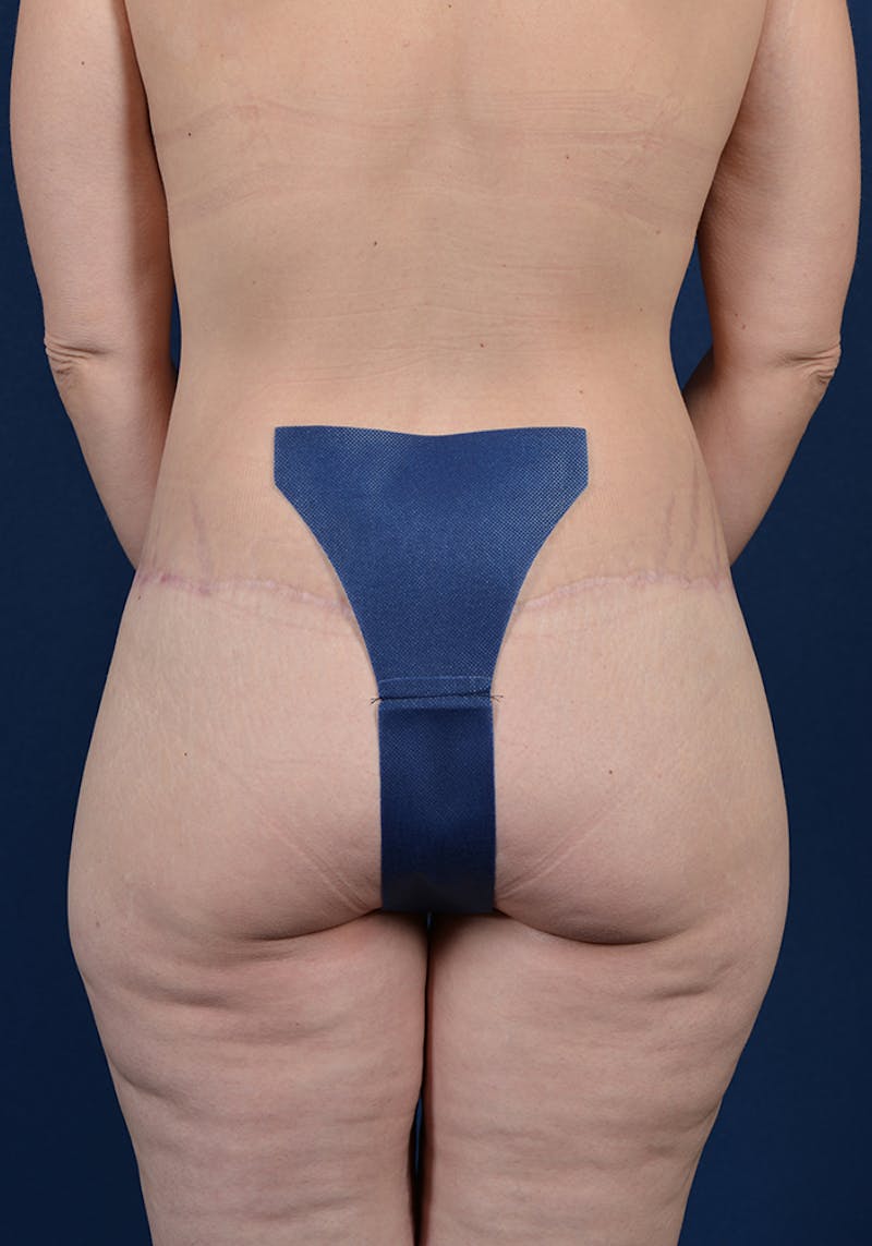 Buttock Recontouring Before & After Gallery - Patient 9694837 - Image 2