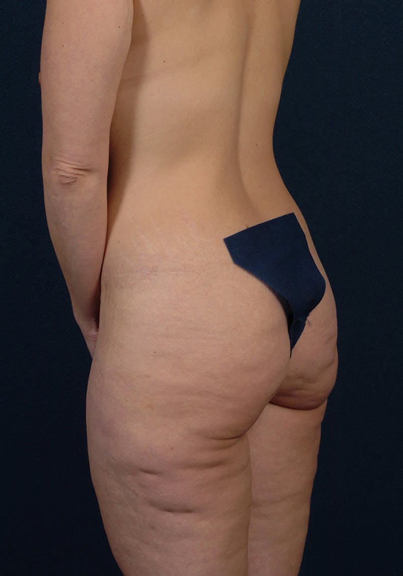 Buttock Recontouring Before & After Gallery - Patient 9694837 - Image 3