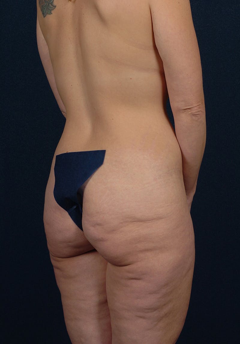 Buttock Recontouring Gallery - Patient 9694837 - Image 5