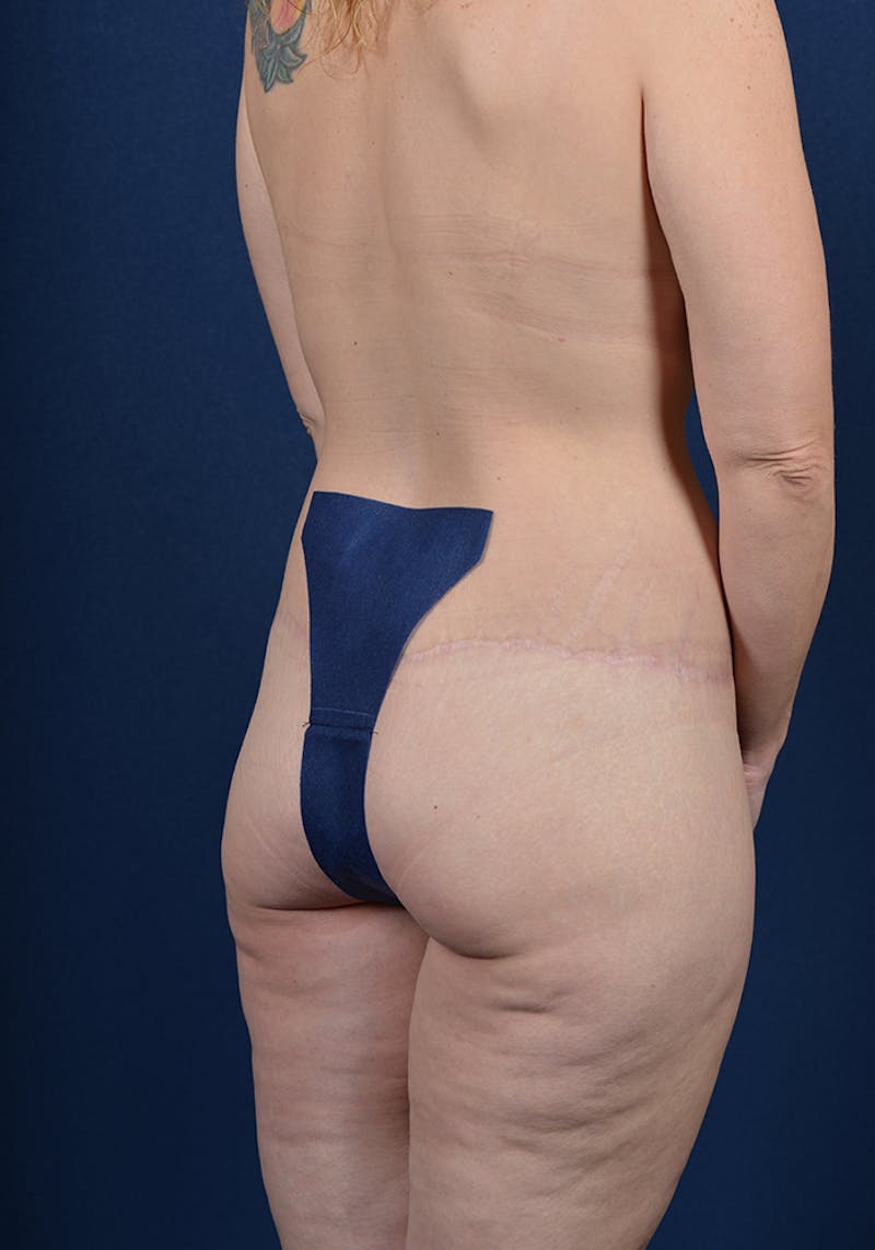 Buttock Recontouring Gallery - Patient 9694837 - Image 6