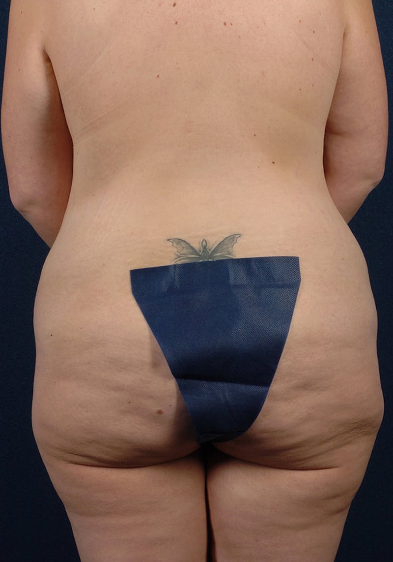 Buttock Recontouring Before & After Gallery - Patient 9694846 - Image 1