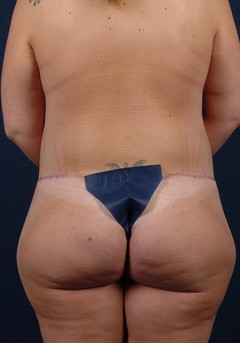 Buttock Recontouring Before & After Gallery - Patient 9694846 - Image 2
