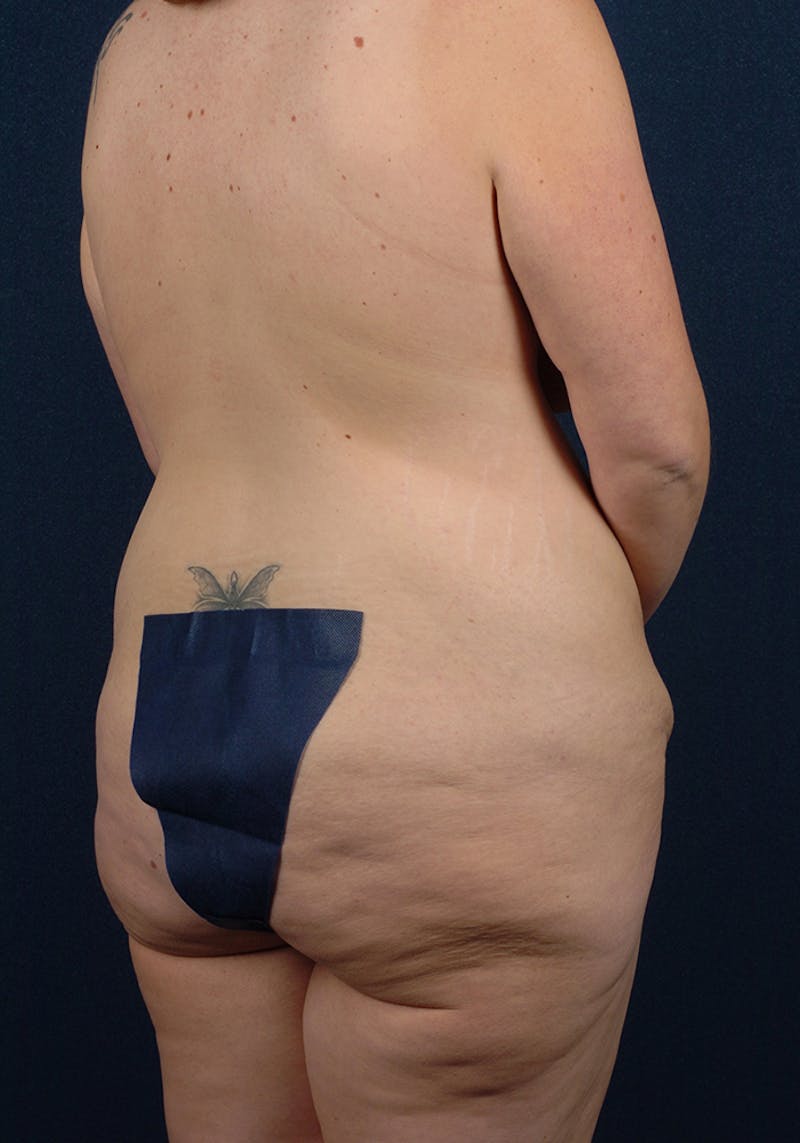 Buttock Recontouring Before & After Gallery - Patient 9694846 - Image 3