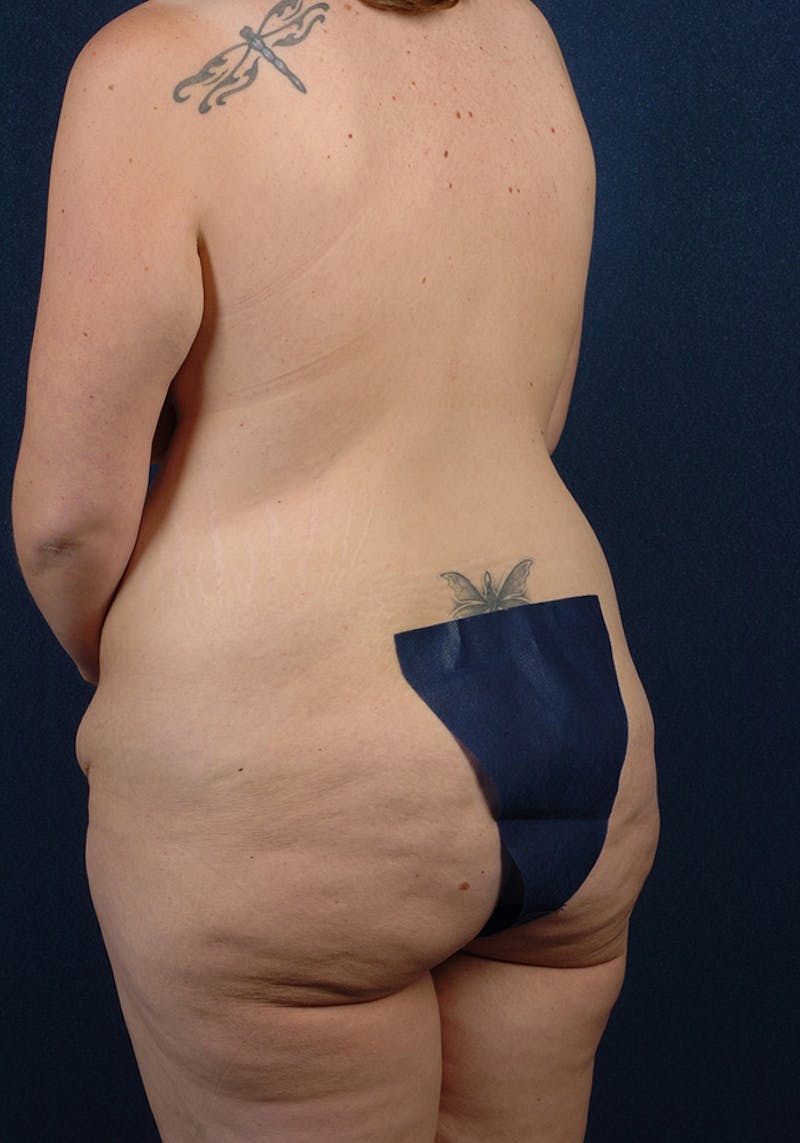 Buttock Recontouring Before & After Gallery - Patient 9694846 - Image 5