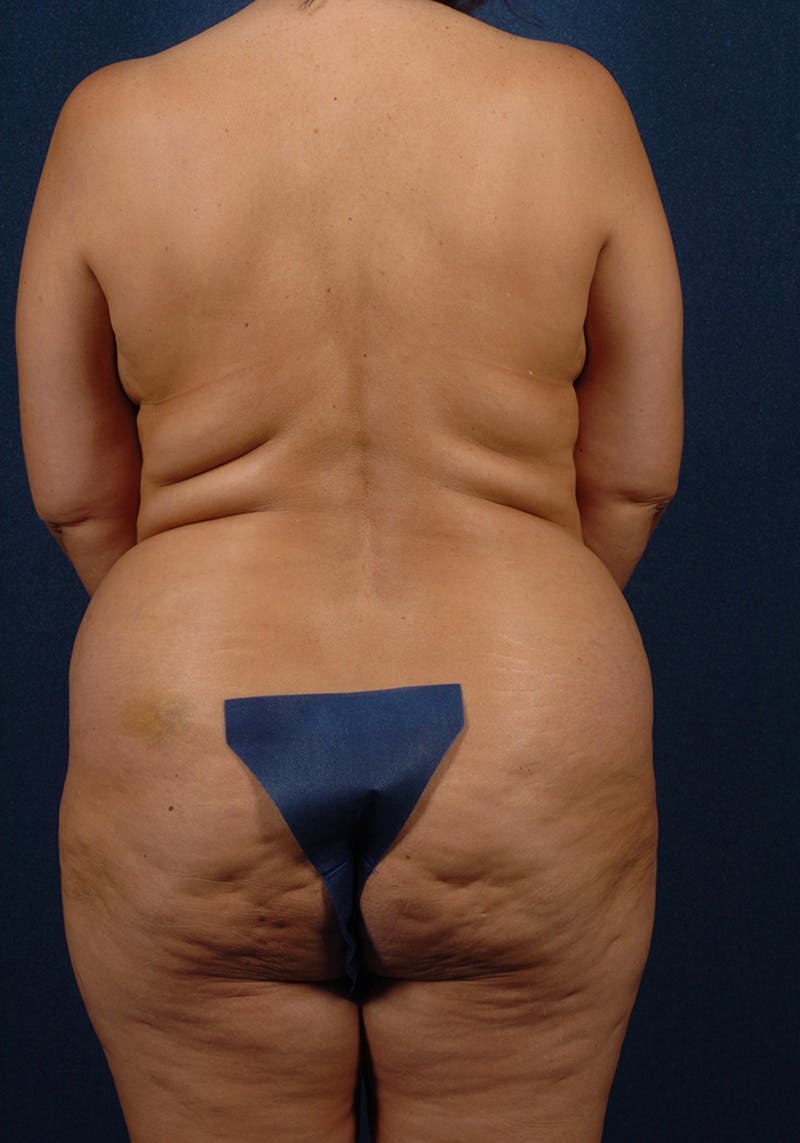 Lower Body Lift Before & After Gallery - Patient 9694847 - Image 7