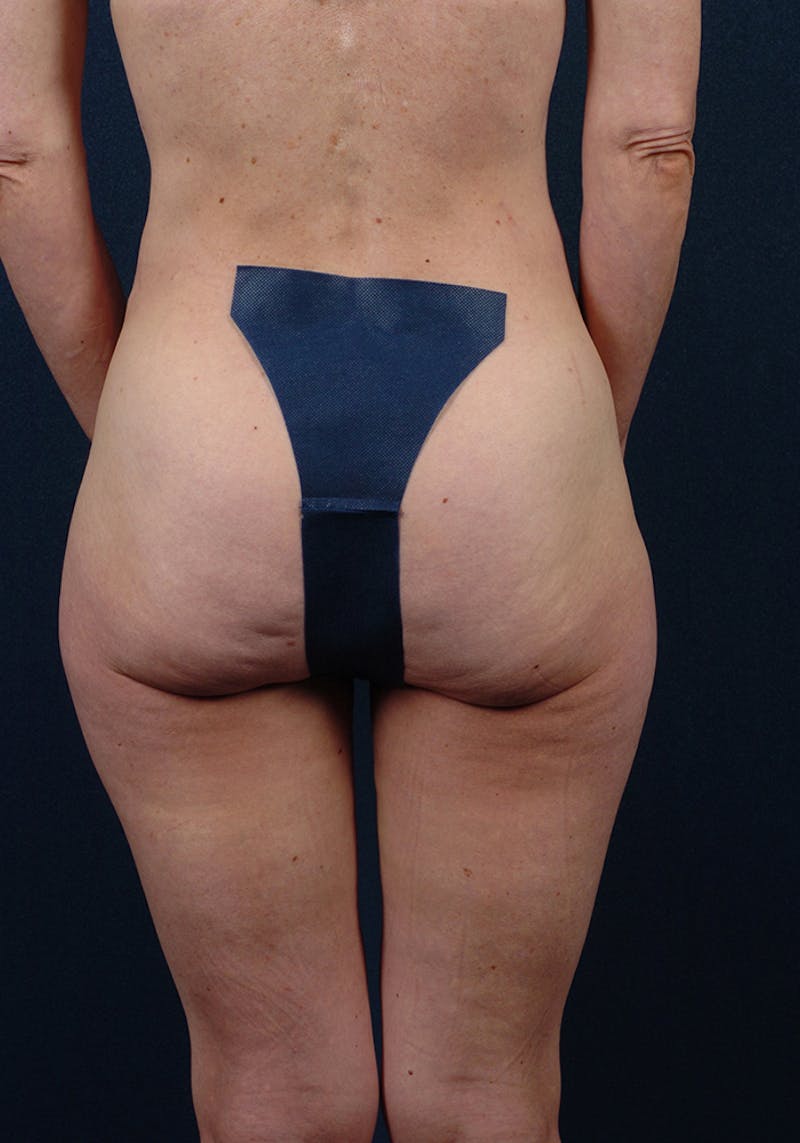 Buttock Recontouring Gallery - Patient 9696040 - Image 1