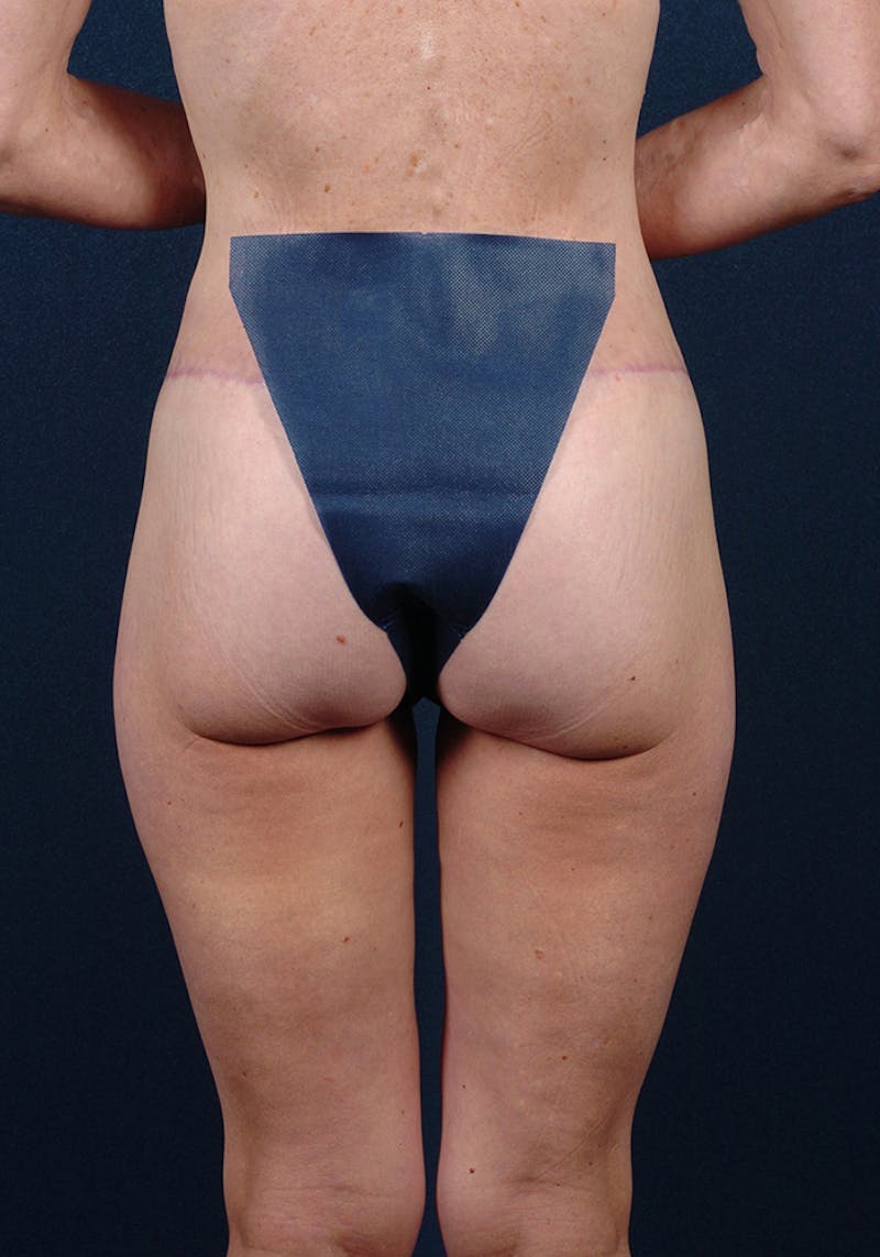 Buttock Recontouring Before & After Gallery - Patient 9696040 - Image 2