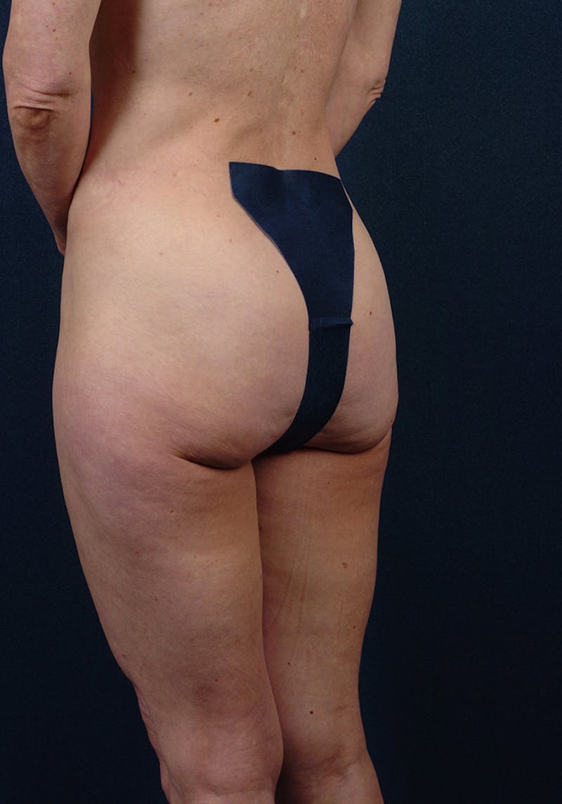 Buttock Recontouring Gallery - Patient 9696040 - Image 3