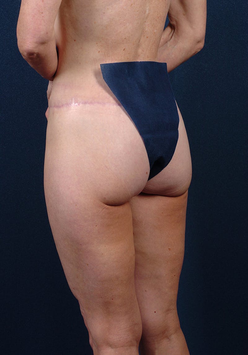 Buttock Recontouring Before & After Gallery - Patient 9696040 - Image 4