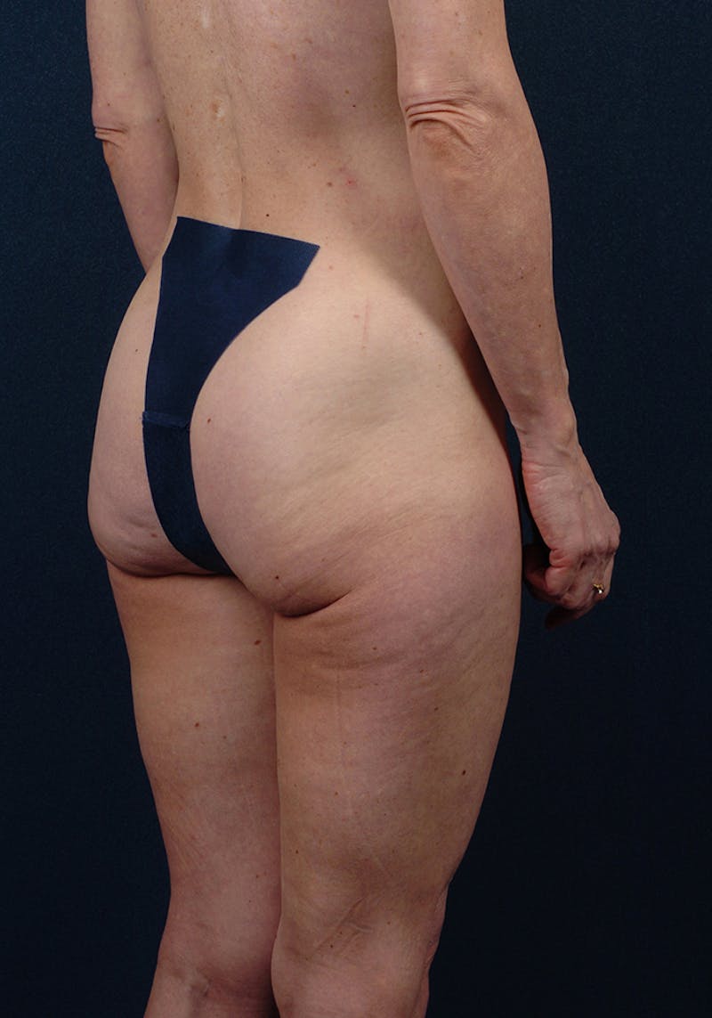 Buttock Recontouring Before & After Gallery - Patient 9696040 - Image 5