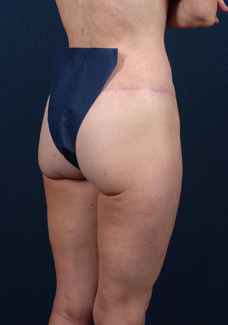 Buttock Recontouring Before & After Gallery - Patient 9696040 - Image 6