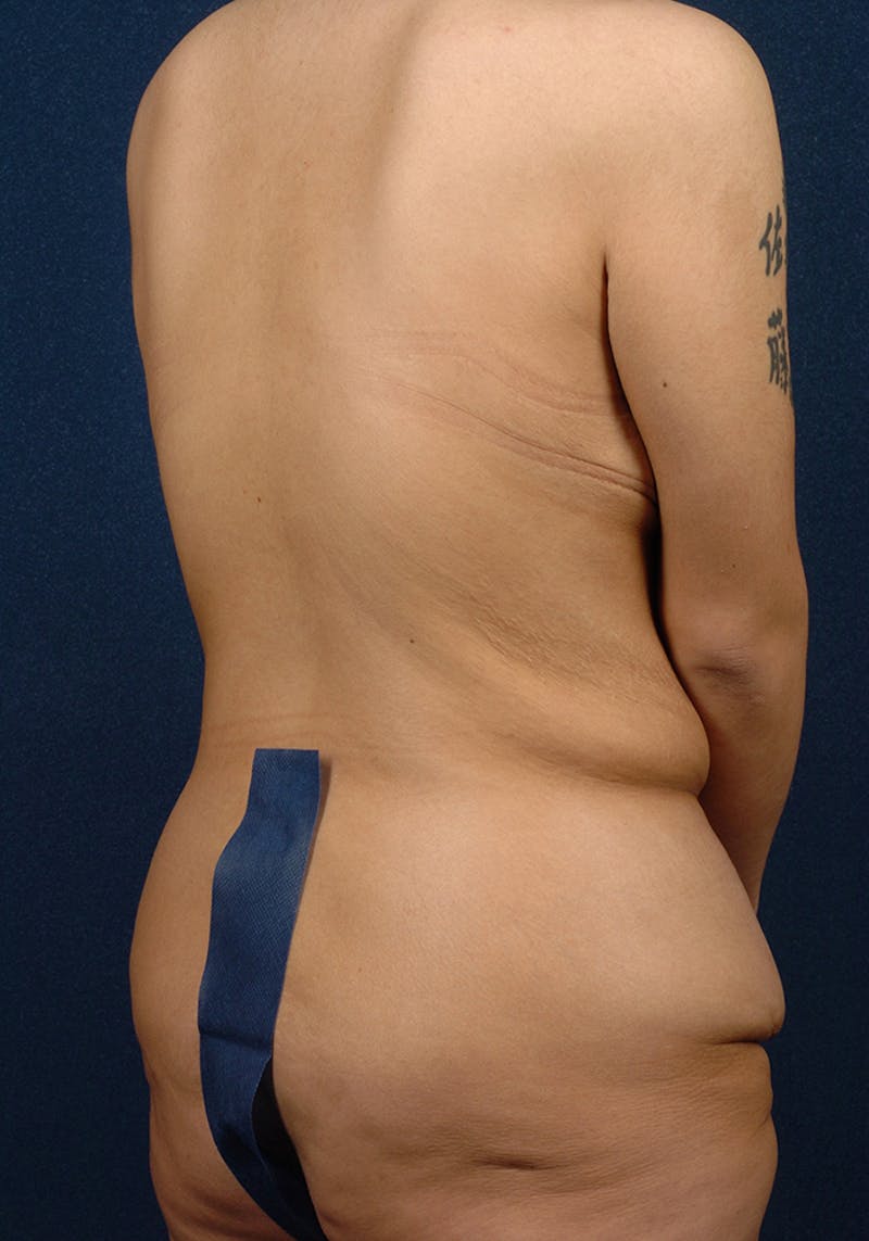 Lower Body Lift Before & After Gallery - Patient 9696233 - Image 5